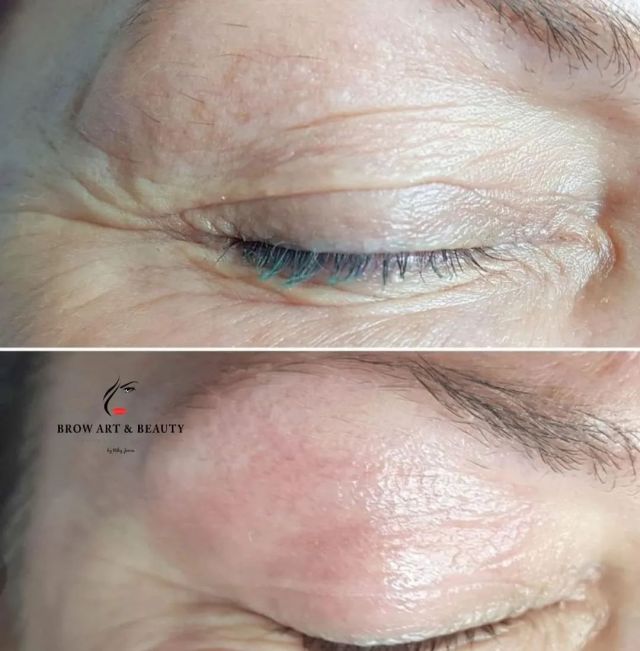 Plasma pro skin tightening ✨️💗