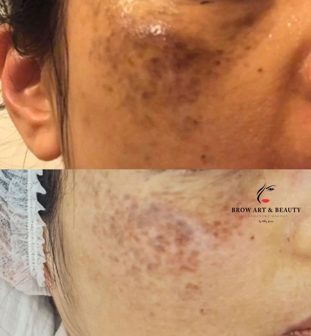 Pigmentation treatment removal 
2 treatment for this case 💗
#Pigmentation #facialAuckland  #Tauranga #pigmentationtreatment #pigmentationremoval #Auckland #rejuvination #beauty #beautyface
