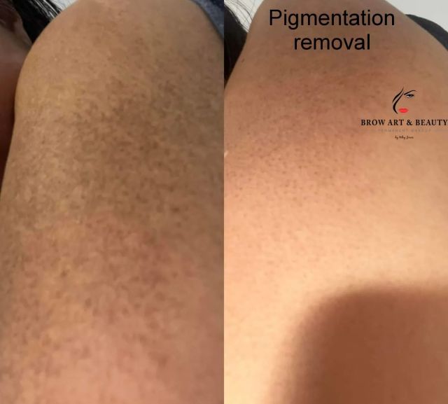 Result of Pigmentation removal after 2 sessions.
#skinconfidence #betterskin #Transformation #Browartandbeauty #aucklandskintreatment #taurangaskinspecialist